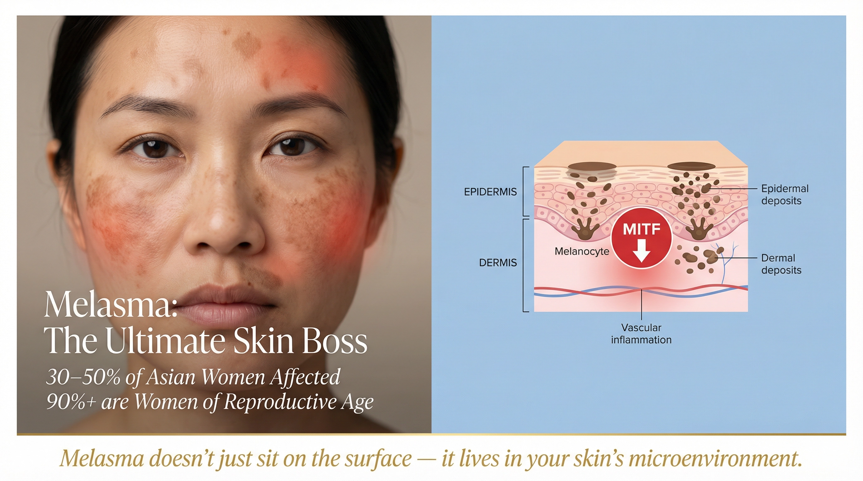 Exosomes and Melasma: A Smarter Way to Treat Stubborn Pigmentation