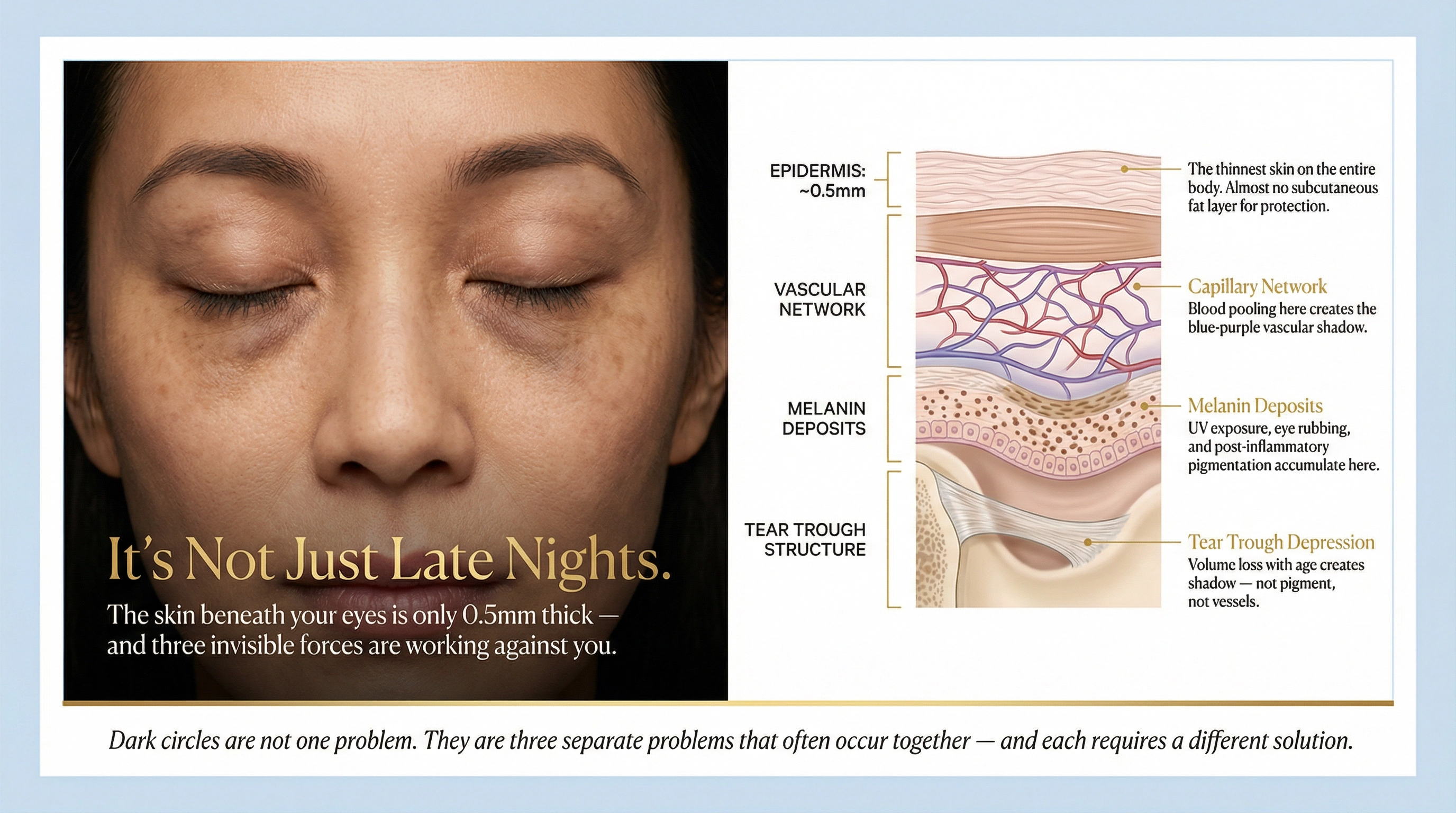 Exosomes and Dark Circles: Banish the "Grey Zone" Beneath Your Eyes